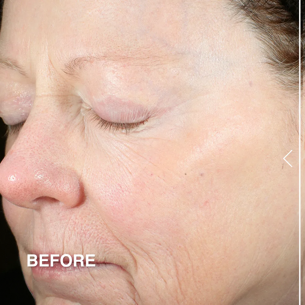 Advanced Peptides and Flora-Collagen™ Serum